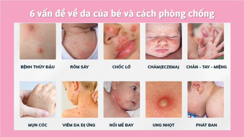 6 vấn đề về da của bé và cách phòng chống